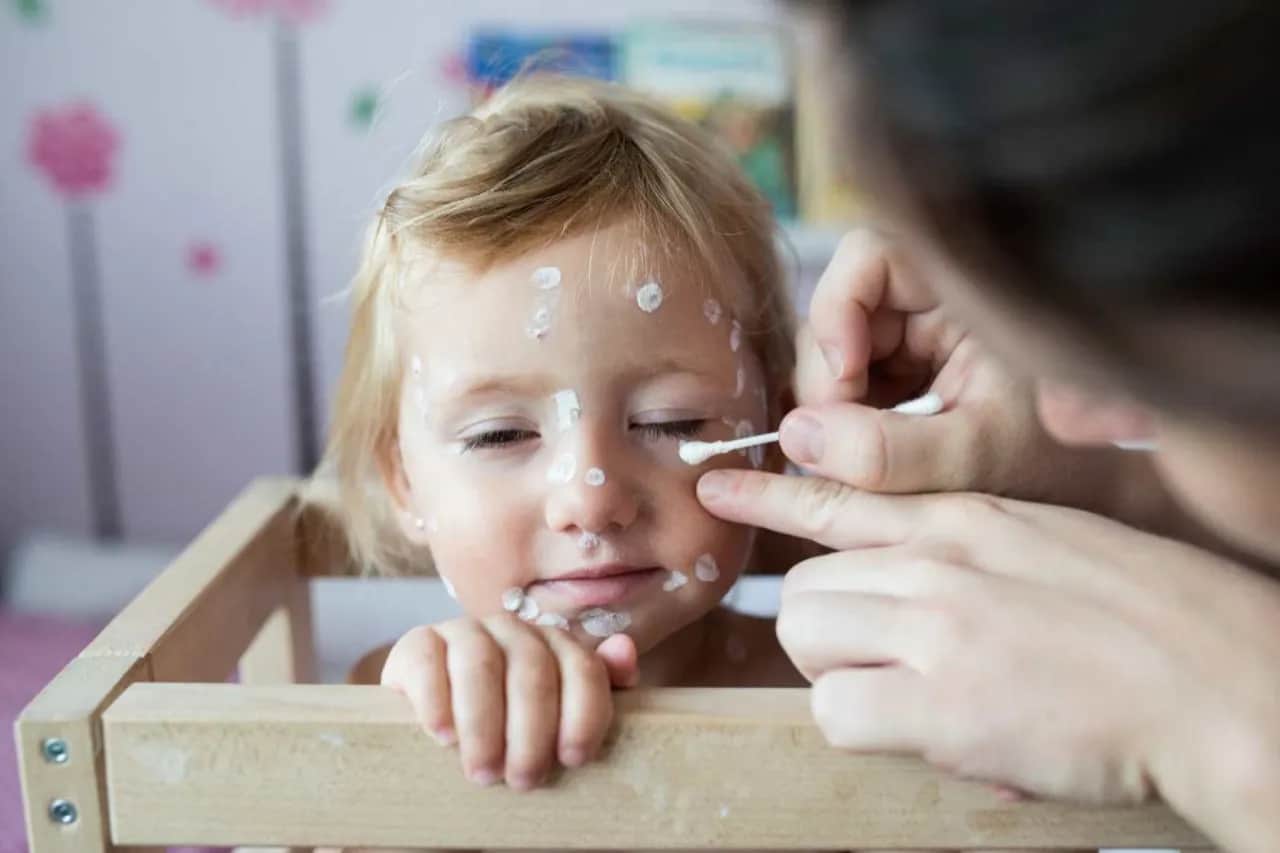 Ile czasu po ospie do przedszkola? Ważne informacje dla rodziców